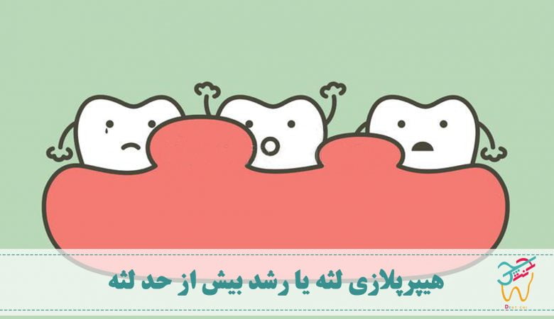هایپرپلازی لثه هیپرپلازی لثه