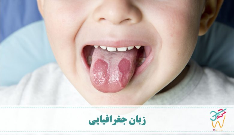 زبان جغرافیایی با این نام شناخته می شود زیرا باعث ایجاد ضایعاتی به شکل جزیره یا نقشه می شود. به طوری که وقتی به زبان نگاه می کنید، ظاهر این لکه ها مانند نقشه است.