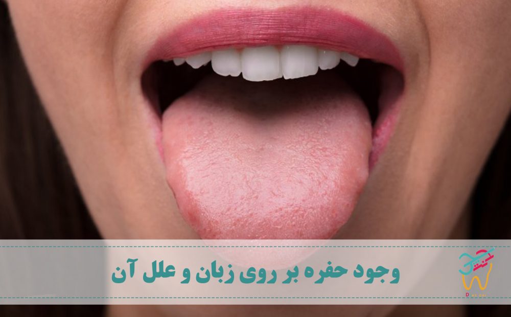 اکثر افراد با مشاهده ی حفره روی زبان یا سوراخ بر روی زبان خود تصور می کنند که دچار سرطان زبان شده اند. اما باید بدانید که احتمال ابتلا به این سرطان بسیار کم است. مطالعات نشان می دهد که شانس ابتلا به سرطان زبان در مقایسه با سایر سرطان ها تنها یک درصد است.