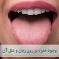 اکثر افراد با مشاهده ی حفره روی زبان یا سوراخ بر روی زبان خود تصور می کنند که دچار سرطان زبان شده اند. اما باید بدانید که احتمال ابتلا به این سرطان بسیار کم است. مطالعات نشان می دهد که شانس ابتلا به سرطان زبان در مقایسه با سایر سرطان ها تنها یک درصد است.
