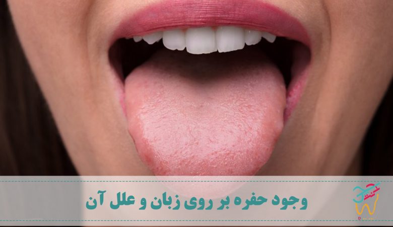اکثر افراد با مشاهده ی حفره روی زبان یا سوراخ بر روی زبان خود تصور می کنند که دچار سرطان زبان شده اند. اما باید بدانید که احتمال ابتلا به این سرطان بسیار کم است. مطالعات نشان می دهد که شانس ابتلا به سرطان زبان در مقایسه با سایر سرطان ها تنها یک درصد است.