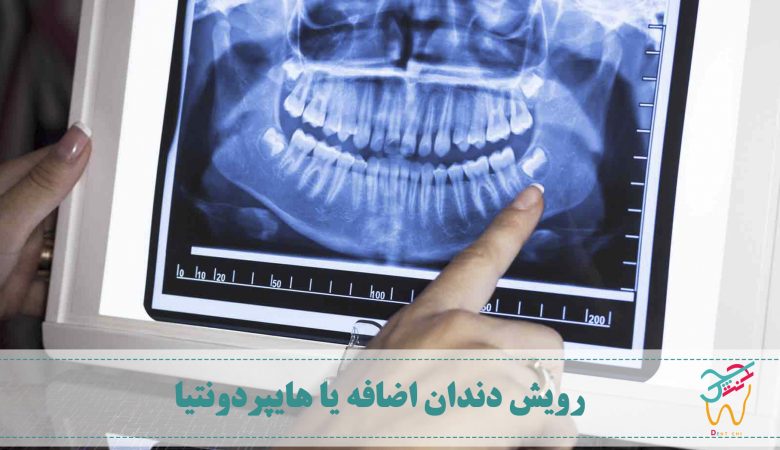 رویش دندان های اضافه در دهان را هایپردونتیا (به انگلیسی: hyperdontia) می نامند.