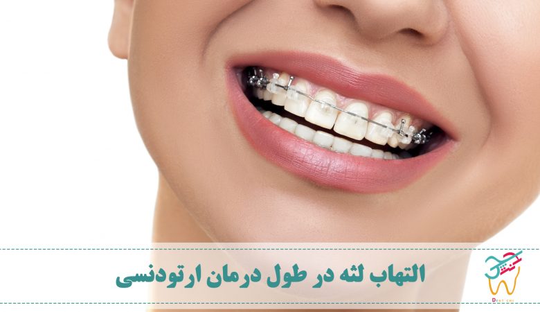 التهاب لثه در طول درمان ارتودنسی می تواند نشان دهنده ی ابتلا به بیماری لثه و یا التهاب لثه نیز باشد.