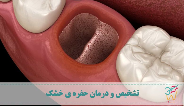 حفره ی خشک یا درای ساکت (به انگلیسی: Dry socket) معمولا بعد از کشیدن دندان ایجاد می شود. به این عارضه ورم استخوان سوراخدار یا اُستئیت آلوئولار (به انگلیسی: Alveolar osteitis) و آرَک‌آماس هم می‌گویند.