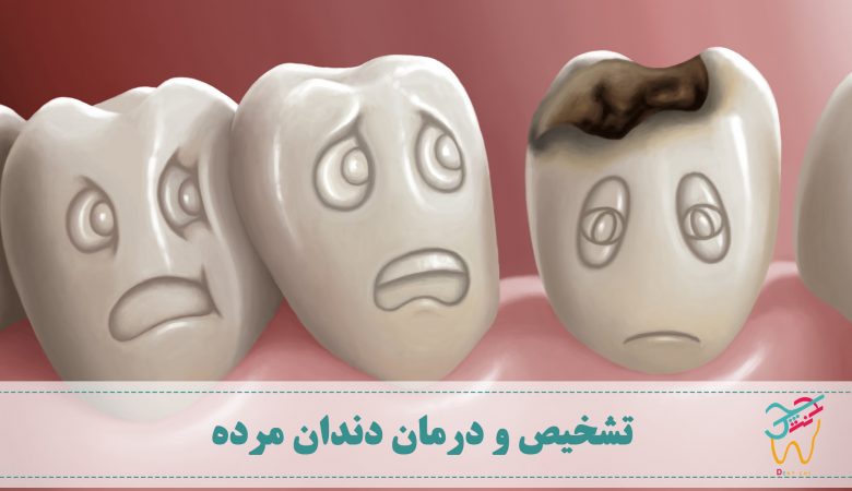 تشخیص و درمان دندان مرده و علت و درمان مرگ دندان