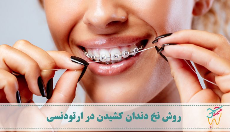 تمیز کردن دندان ها و روش نخ دندان کشیدن در ارتودنسی اهمیت دو چندان دارد چرا که با وجود براکت ها و سیم ها تمیز کردن دندان ها دشوارتر است.