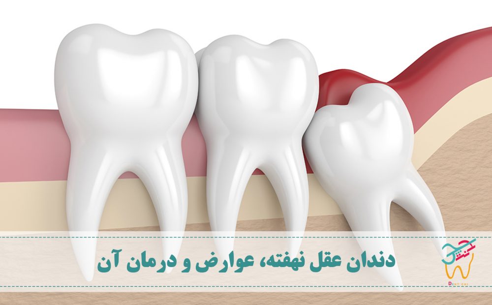 به دندان عقلی که در لثه گیر کند یا فضای کافی برای در آمدن نداشته باشد، دندان عقل نهفته گفته می شود. احتمال پوسیدگی دندان نهفته بیشتر از دندان های عادی است.