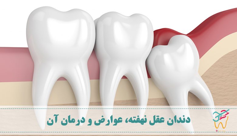 به دندان عقلی که در لثه گیر کند یا فضای کافی برای در آمدن نداشته باشد، دندان عقل نهفته گفته می شود. احتمال پوسیدگی دندان نهفته بیشتر از دندان های عادی است.