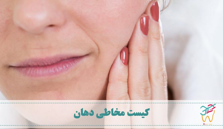 کیست مخاطی دهان یا موکوسل یا موکسل