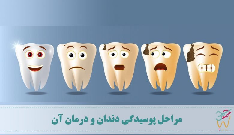 مراحل پوسیدگی دندان و درمان پوسیدگی دندان، ارتباط آبسه و پوسیدگی دندان، پوسیدگی دندان