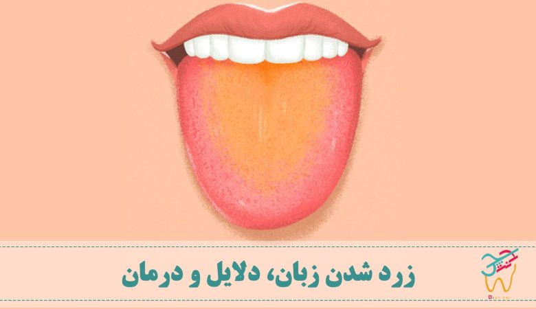 زرد شدن رنگ زبان اعلب خطر خاصی ندارد و به مرور زمان از بین می رود.
