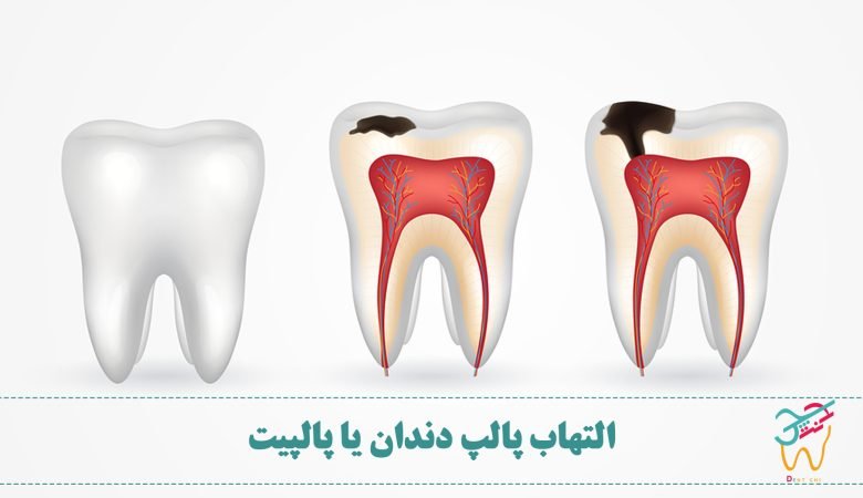 التهاب پالپ دندان یا پالپیت (به انگلیسی Pulpitis) بیماری است که باعث التهاب دردناک پالپ می شود. پالپ در بخش داخلی دندان است که شامل اعصاب و رگ های خونی است.