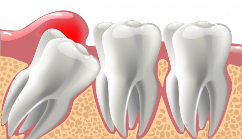 15 راهکار برای تسکین درد دندان عقل