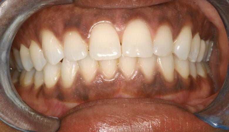 7 علت تشکیل لکه‌های سیاه روی لثه‌ها