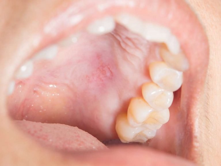 برآمدگی در سقف دهان؛ عوامل و درمان