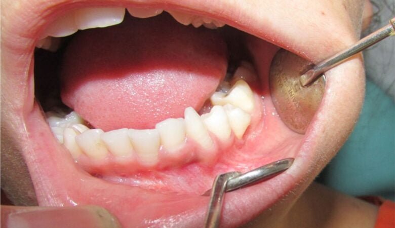 کیست دنتی ژروس چیست؟