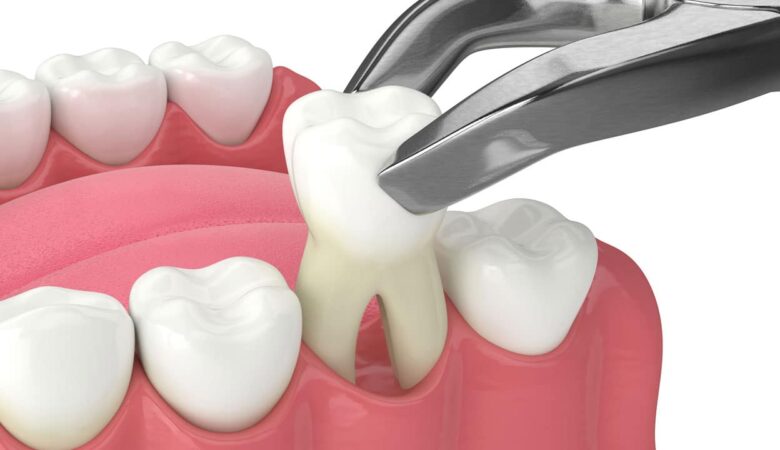 آیا کشیدن دندان درد دارد؟