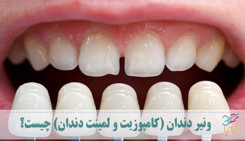 ونیر دندان (کامپوزیت و لمینت دندان) چیست؟