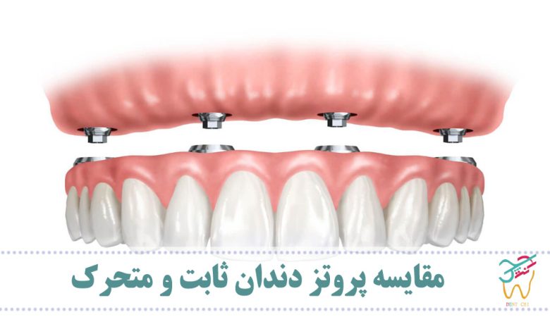 مقایسه پروتز دندان ثابت و متحرک