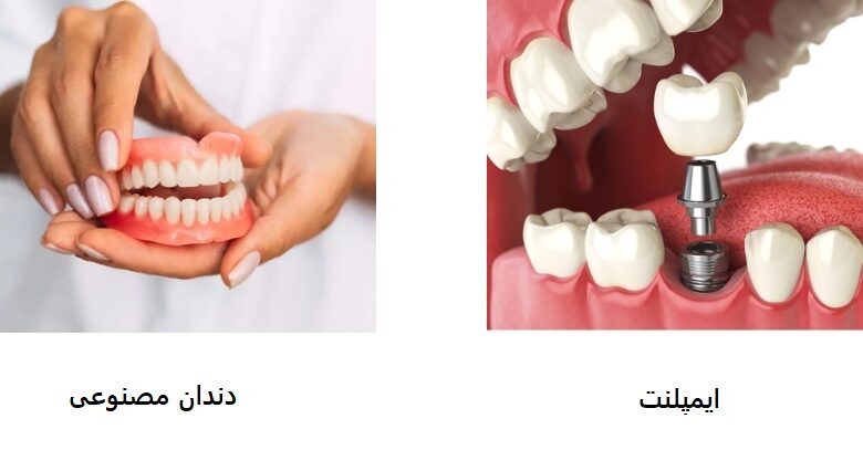 مقایسه دندان مصنوعی و ایمپلنت