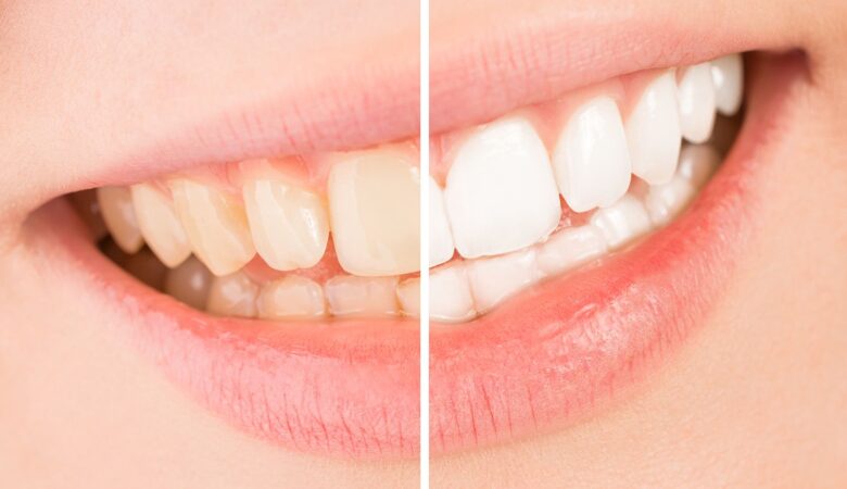 تغییر رنگ دندان‌ها در طول درمان ارتودنسی