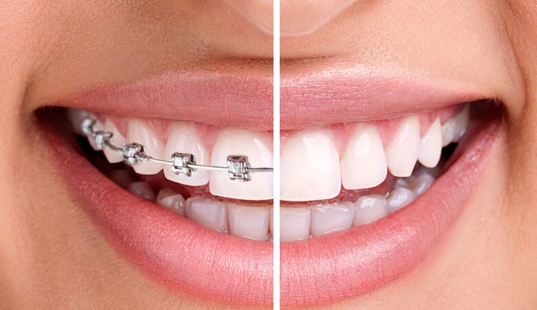 روش‌های جایگزین ارتودنسی برای منظم کردن دندان‌ها