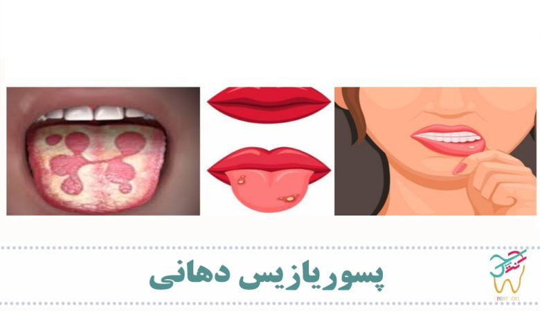 پسوریازیس دهانی چیست؟