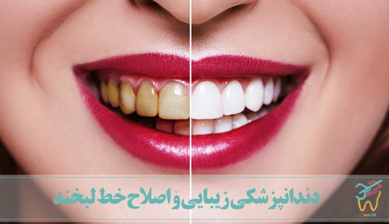 دندانپزشکی زیبایی و اصلاح خط لبخند
