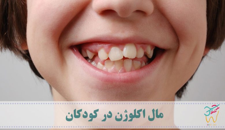 مال اکلوژن در کودکان