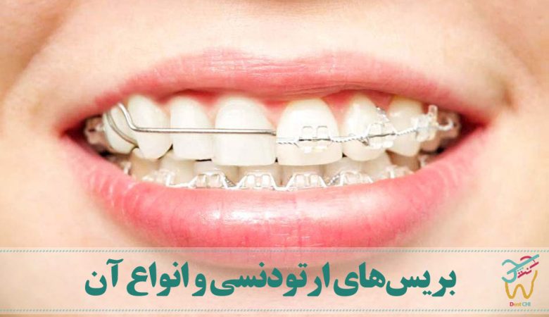 بریس‌های ارتودنسی و انواع آن