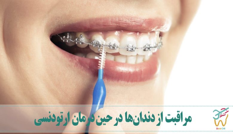 مراقبت از دندان‌ها در حین درمان ارتودنسی
