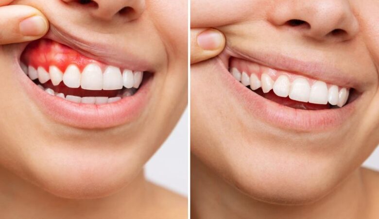 کانتورینگ لثه