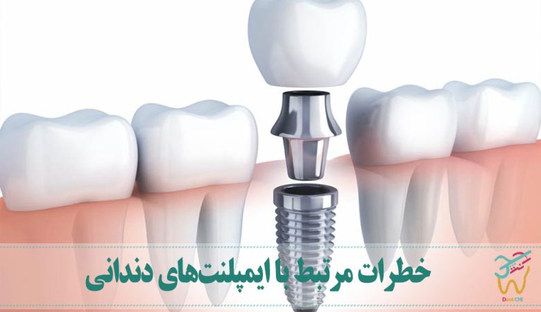 خطرات مرتبط با ایمپلنت‌های دندانی