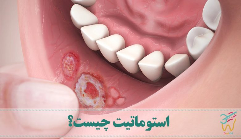 استوماتیت چیست؟