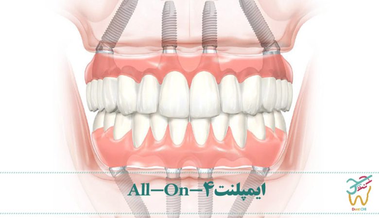ایمپلنت دندانی All-On-4