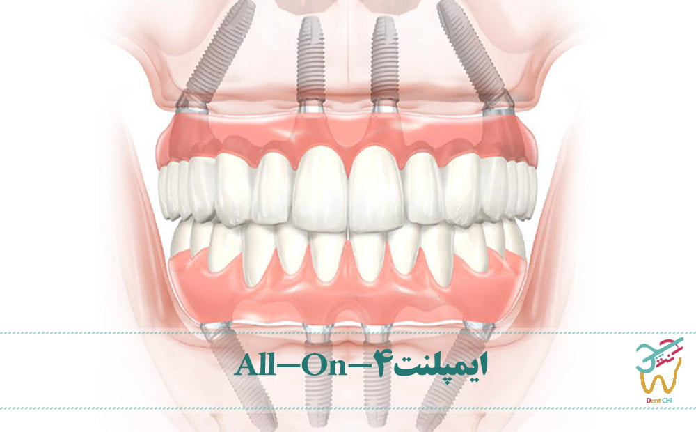 ایمپلنت دندانی All-On-4