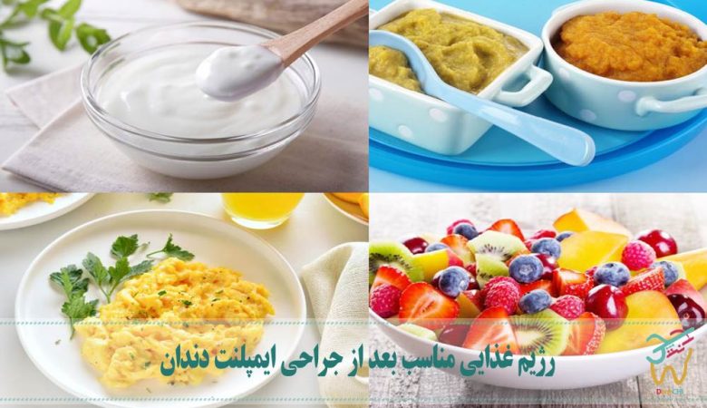رژیم غذایی مناسب بعد از جراحی ایمپلنت‌ دندان