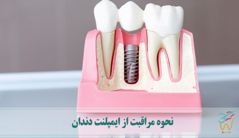 نحوه مراقبت از ایمپلنت دندان
