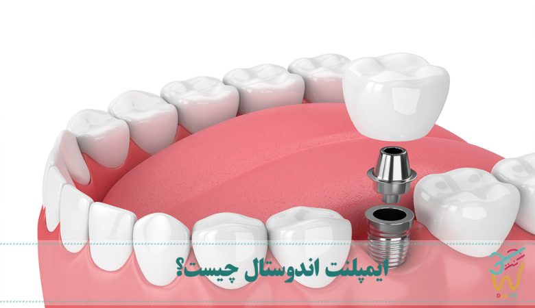ایمپلنت اندوستال چیست؟