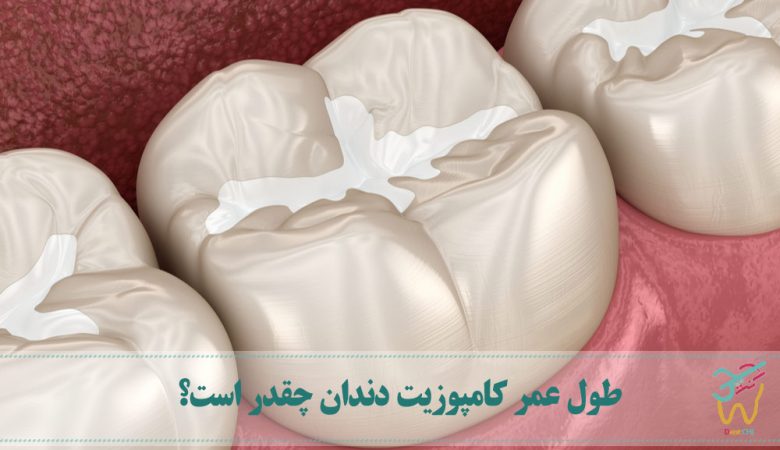 طول عمر کامپوزیت دندان چقدر است؟