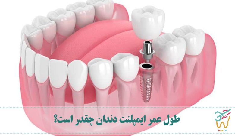 طول عمر ایمپلنت دندان چقدر است؟