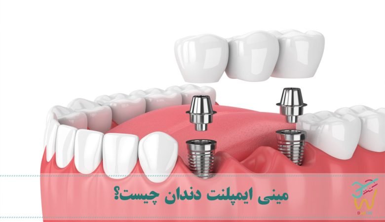 مینی ایمپلنت دندان