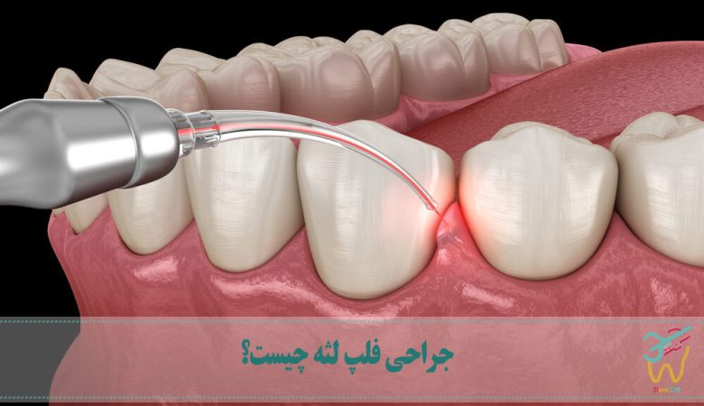 جراحی فلپ لثه چیست؟