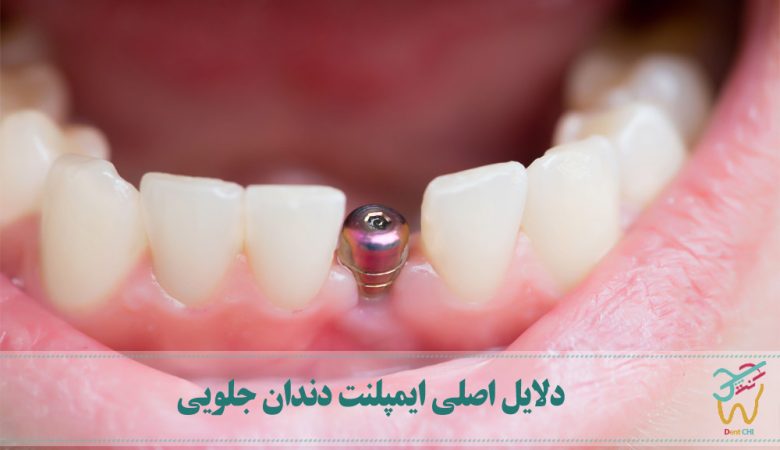 دلایل اصلی ایمپلنت دندان جلویی