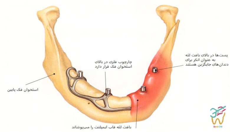 ایمپلنت ساب پریوستئال چیست؟
