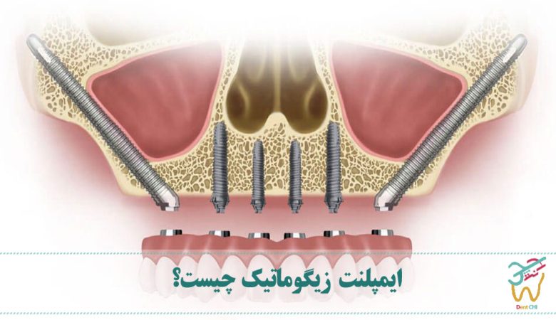 ایمپلنت زیگوماتیک چیست؟