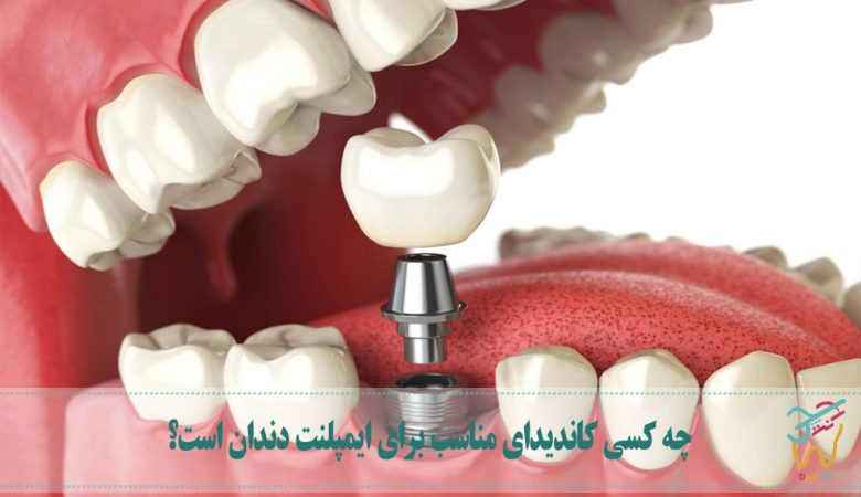 چه کسی کاندیدای مناسب برای ایمپلنت دندان است؟