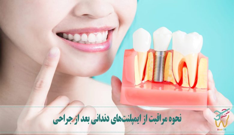 نحوه مراقبت از ایمپلنت‌های دندانی بعد از جراحی