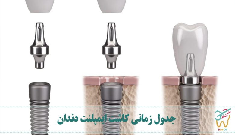 جدول زمانی کاشت ایمپلنت دندان