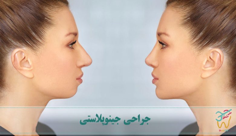 جراحی جینوپلاستی (جراحی چانه)